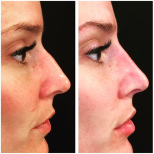 Before and after images of a nose treated with dermal fillers
