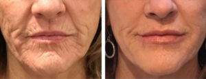 Before and after of the area around the mouth treated with dermal fillers