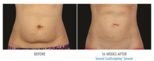 Before and After images of a stomach after CoolSculpting