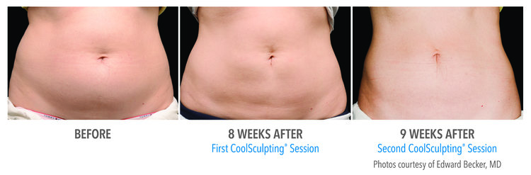 CoolSculpting Results of the stomach area after 9 weeks