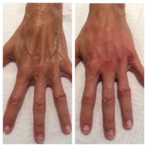 Before and After images of a hand treated with dermal fillers